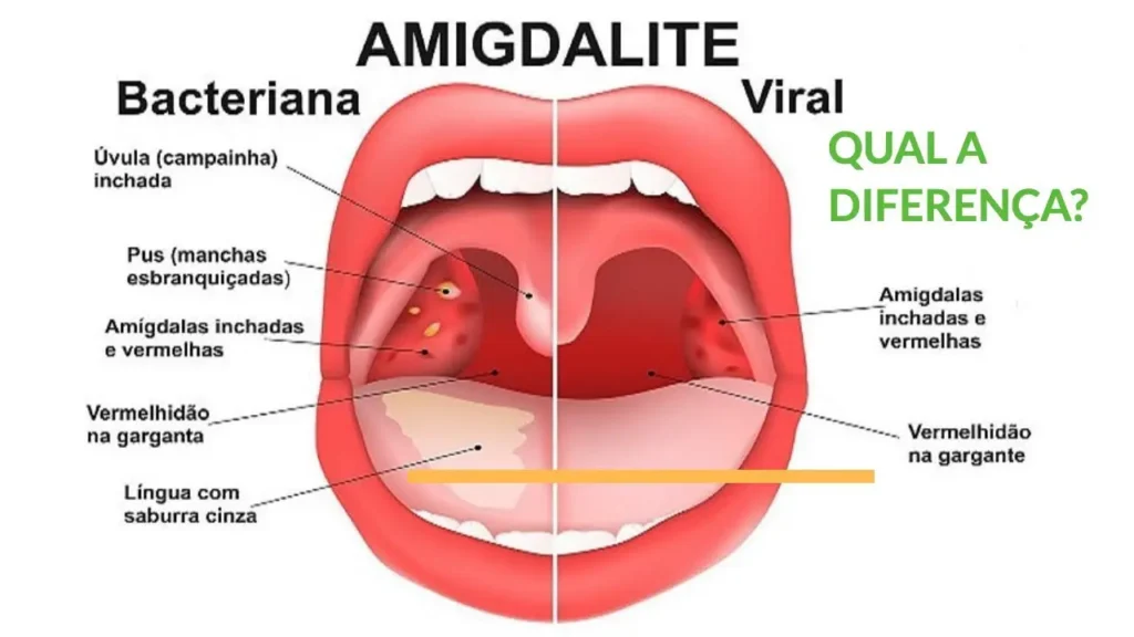 dor de garganta causa