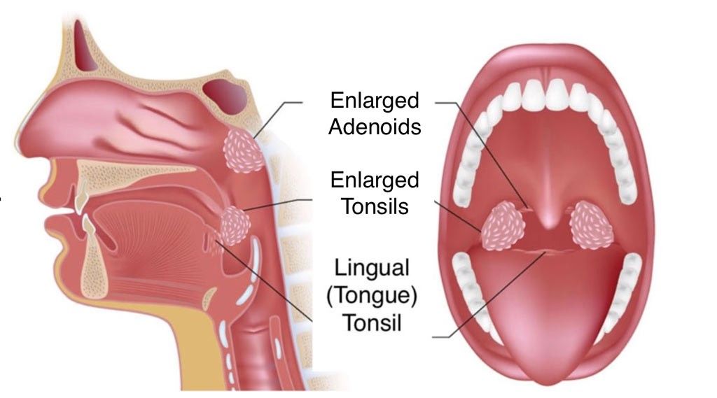 amigdala adenoide
