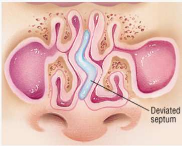 desvio septo nasal